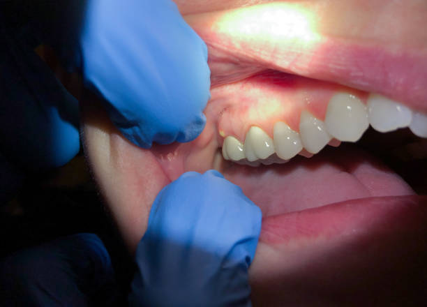 Best Emergency Root Canal Treatment in Bonham, TX